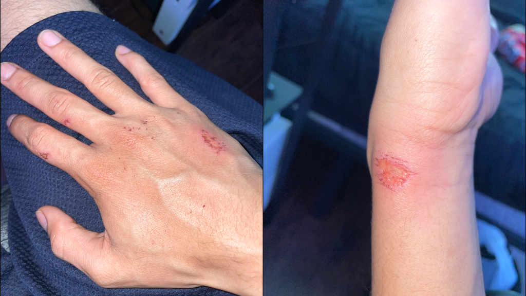 side-by-side pictures of a teenage boys hands with scrapes on them