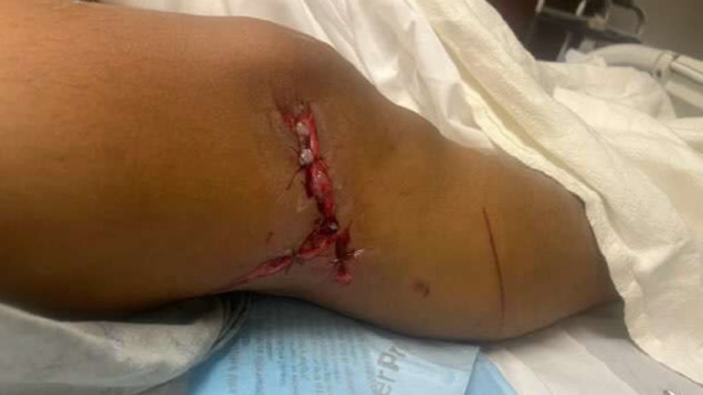 a close up of a man's knee with gruesome stitches through it