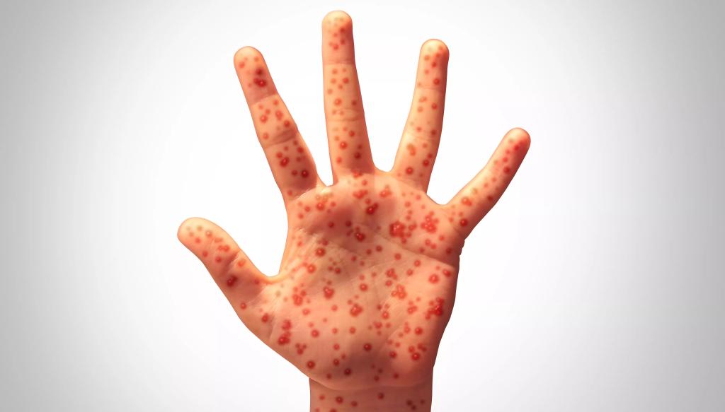 Valley measles outbreak grows: Where you may have been exposed