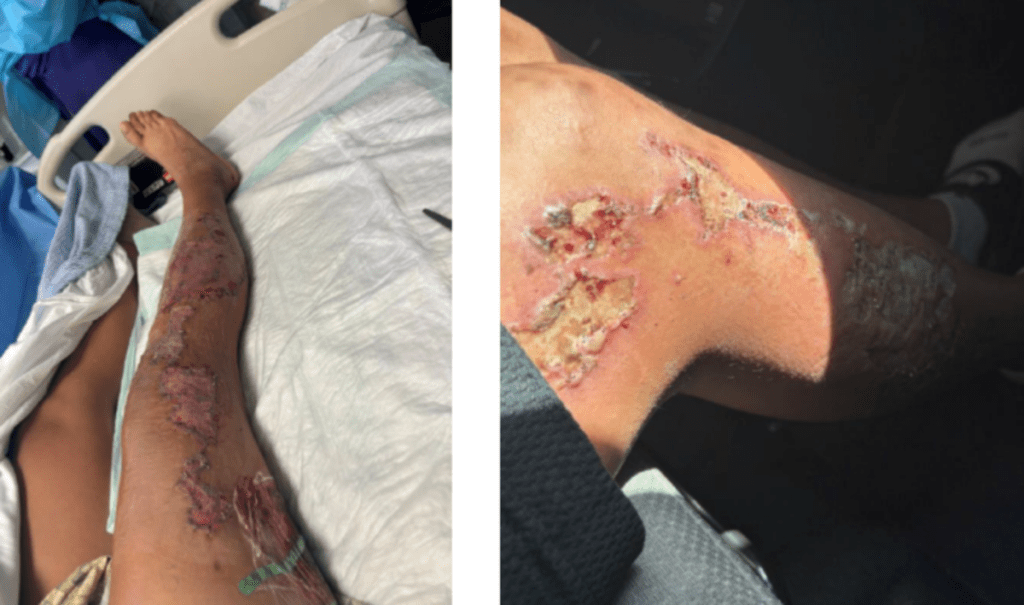 Judge says woman cops held on hot pavement can sue for excessive force