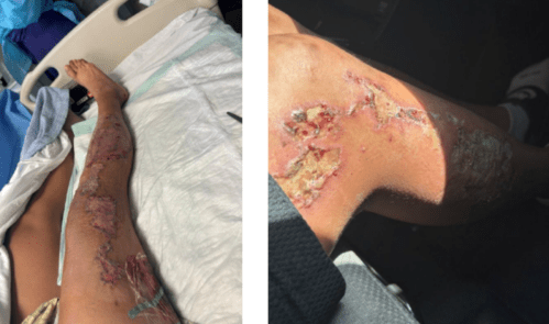 Judge: Woman cops held on hot pavement can sue